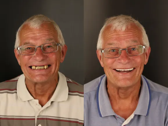 Aponia patient before and after full smile reconstruction