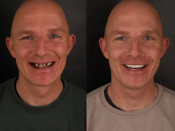 Aponia patient before and after fixed teeth, severe case
