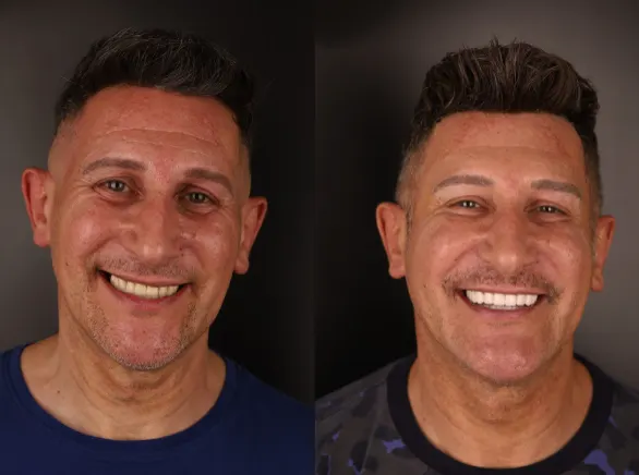 Aponia patient before and after, All-on-X case
