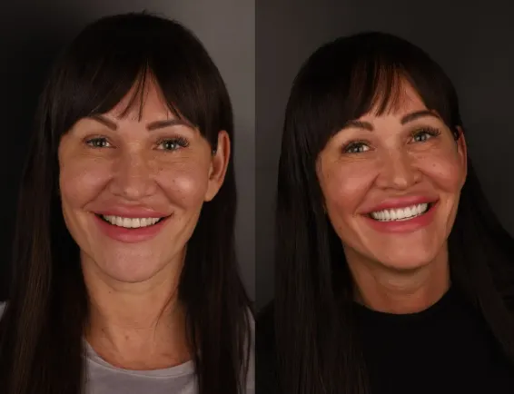 Aponia patient before and after, Hollywood Smile