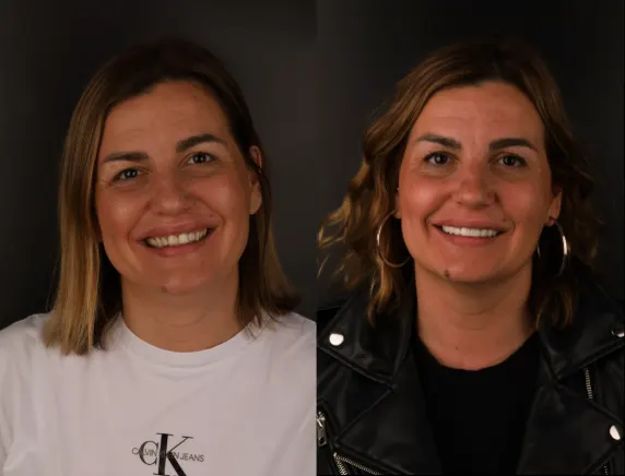 Aponia patient before and after, full arch implants