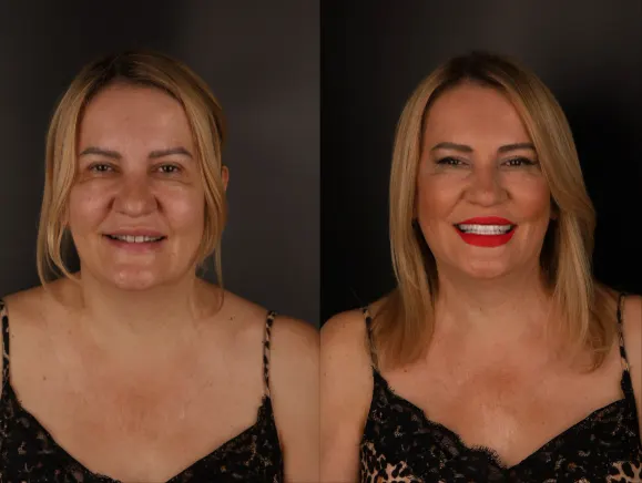 Aponia patient before and after fixed teeth on implants
