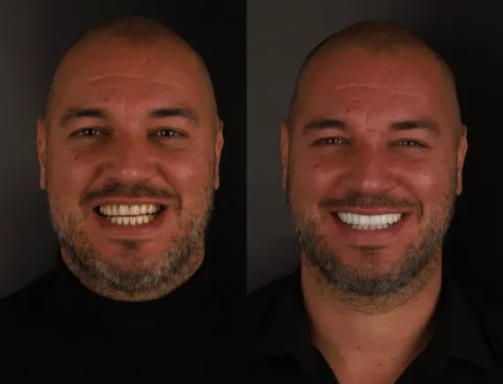 Aponia patient before and after, implants and crowns