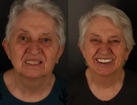 Aponia patient before and after, smile transformation