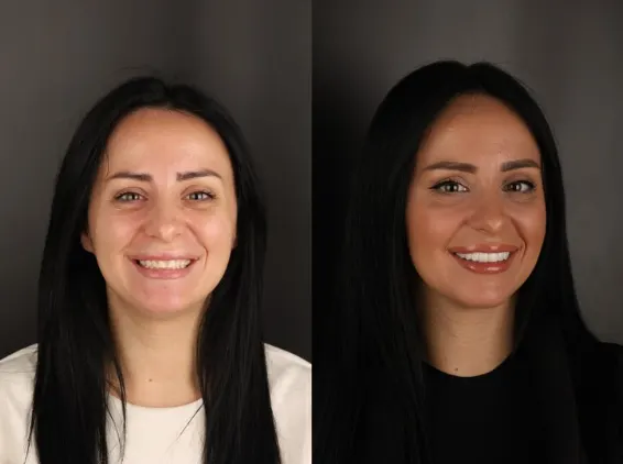 Aponia patient before and after, combined case