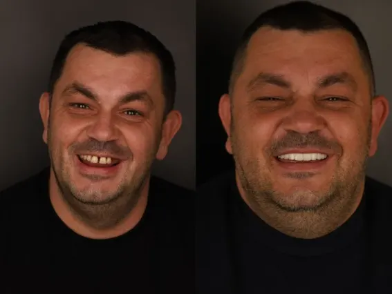 Aponia patient before and after, new smile