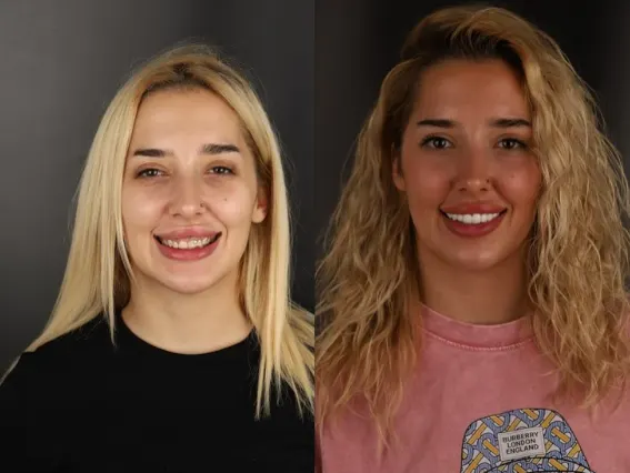 Aponia patient before and after, full mouth work